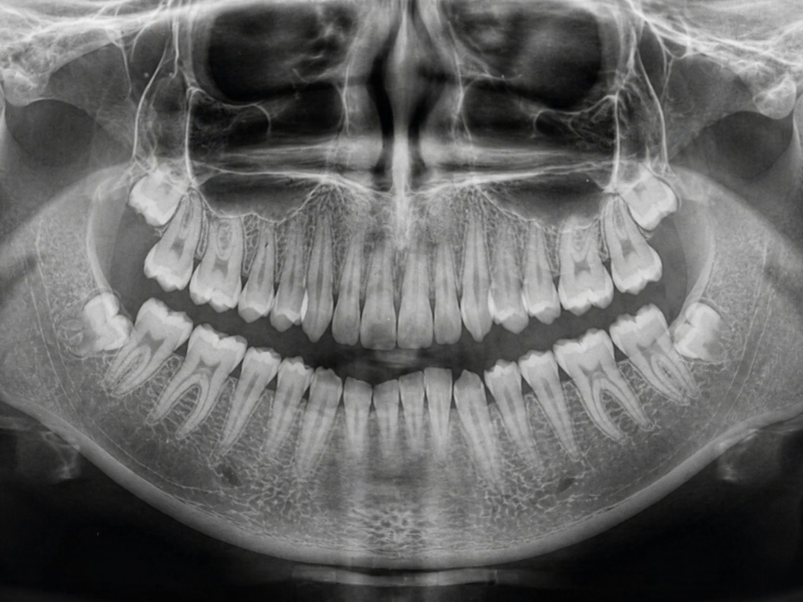 Panoramic dental x-ray